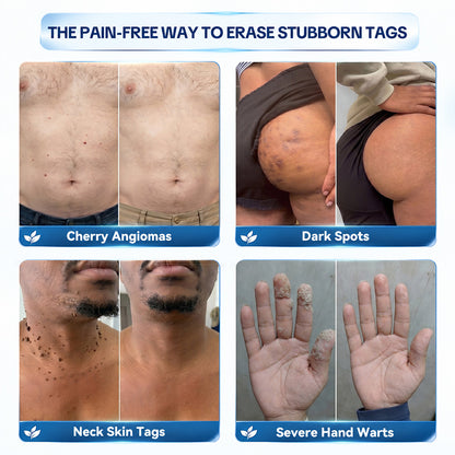 Dyceco® ☑️ | 7-𝐃𝐚𝐲 𝐒𝐤𝐢𝐧 𝐓𝐚𝐠 & 𝐒𝐩𝐨𝐭 𝐄𝐫𝐚𝐬𝐞𝐫 𝐂𝐫𝐞𝐚𝐦 (Zero Pain, Zero 𝐒𝐜𝐚𝐫𝐬 Formula)
