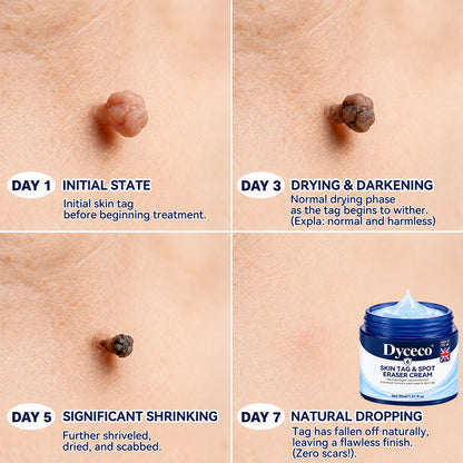 Dyceco® ☑️ | 7-𝐃𝐚𝐲 𝐒𝐤𝐢𝐧 𝐓𝐚𝐠 & 𝐒𝐩𝐨𝐭 𝐄𝐫𝐚𝐬𝐞𝐫 𝐂𝐫𝐞𝐚𝐦 (Zero Pain, Zero 𝐒𝐜𝐚𝐫𝐬 Formula)
